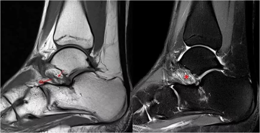 跗骨窦综合征最常见的原因是踝关节内翻扭伤时伴随着踝关节旋后损伤