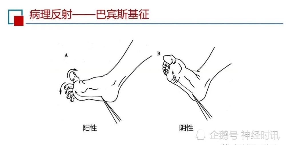 被检查者仰卧,下肢伸直,医生手持被检查者踝部,用钝头竹签划足底外侧