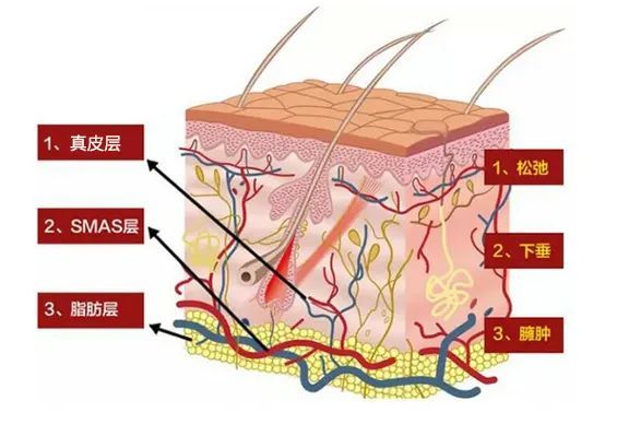 皮肤松弛就会出现兜不住浅层脂肪,组织往下坠,面部缺乏紧实感