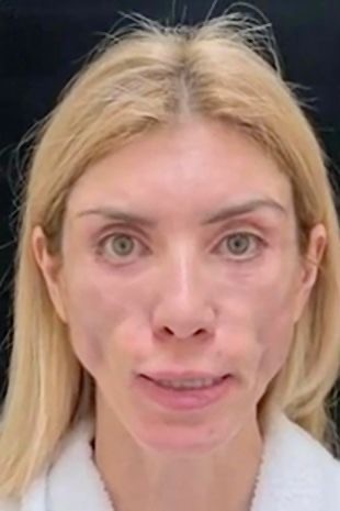 整容有风险俄罗斯选美皇后整容失败无法闭眼也无法微笑