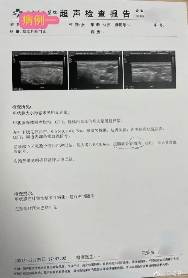 彩超怀疑甲状腺结节恶性,在"不做甲穿或者甲穿没有确诊恶性"的情况下