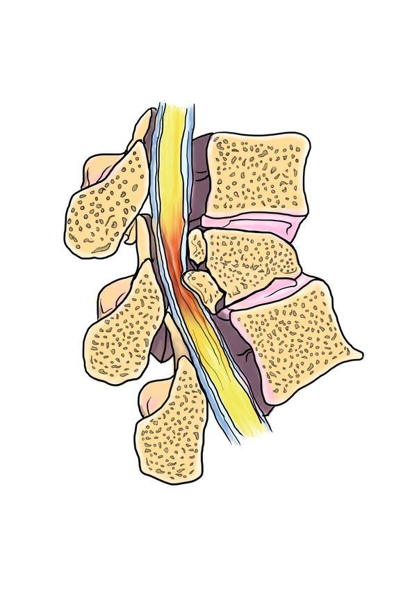 广州和谐医院神经修复医学中心为你介绍脊髓损伤后治疗措施
