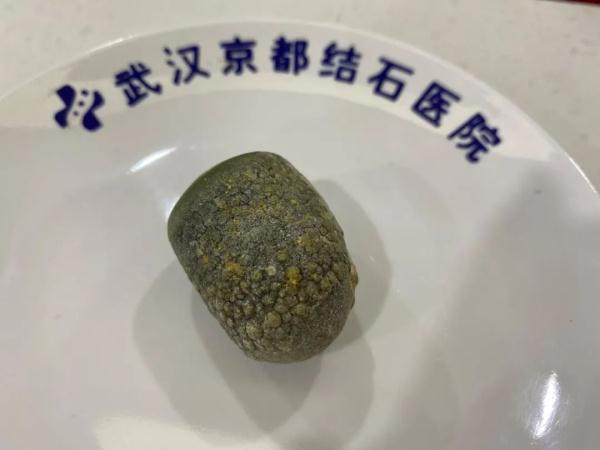 爱吃肥肉,猪蹄,三餐不定,女子腹痛就医胆囊长满结石