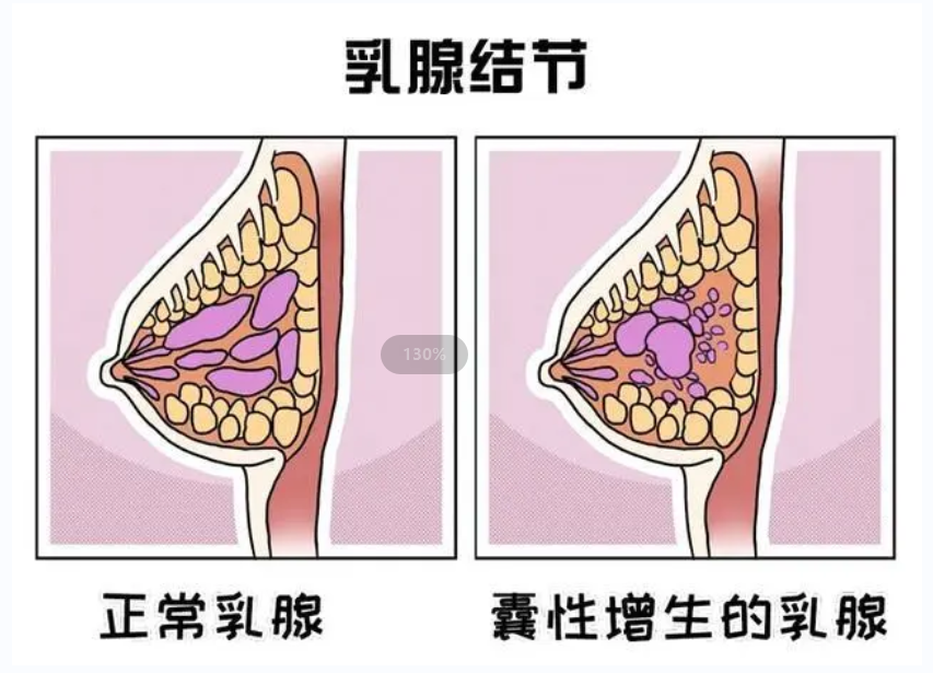 乳腺结节是什么是癌吗