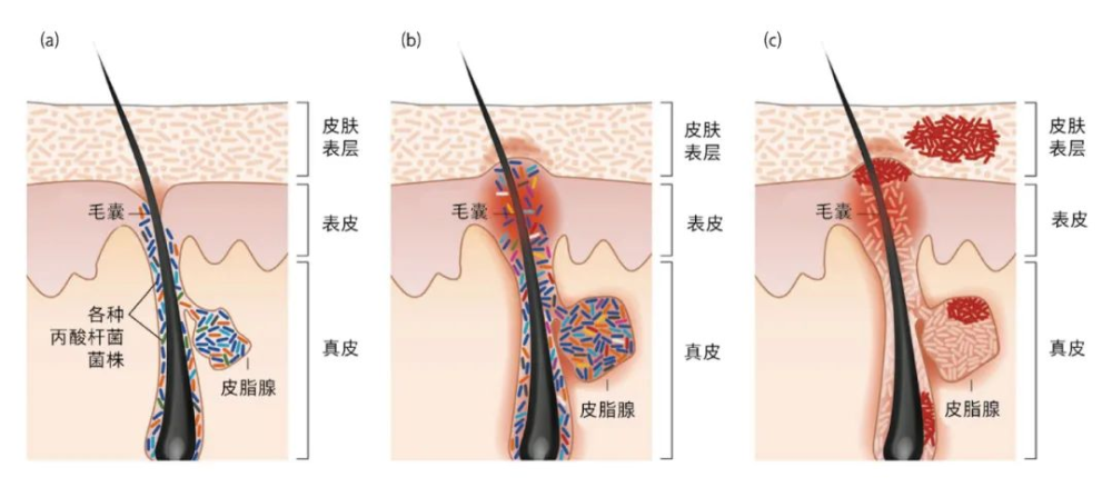 護膚乾貨14:皮脂腺毛囊微生態平衡與痘痘(痤瘡)_騰訊新聞