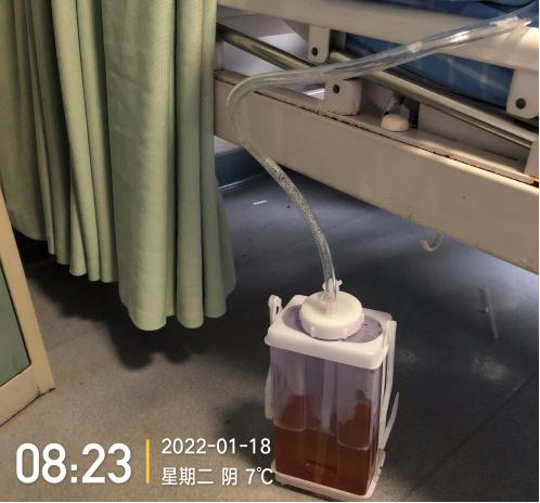 检查后胸腔引流管意外滑脱处理方法来了