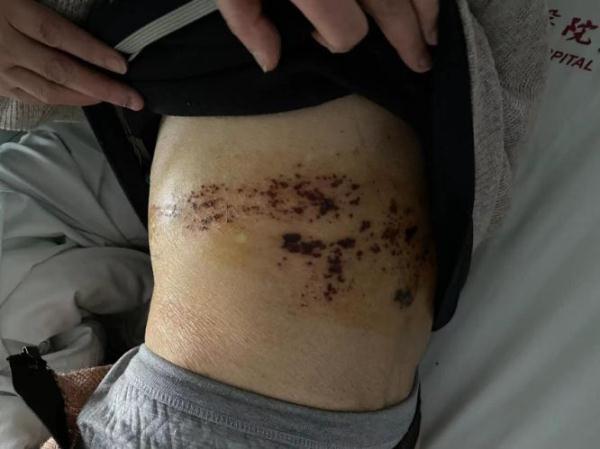 九旬老人患上"蛇缠腰",春季警惕这种好发病