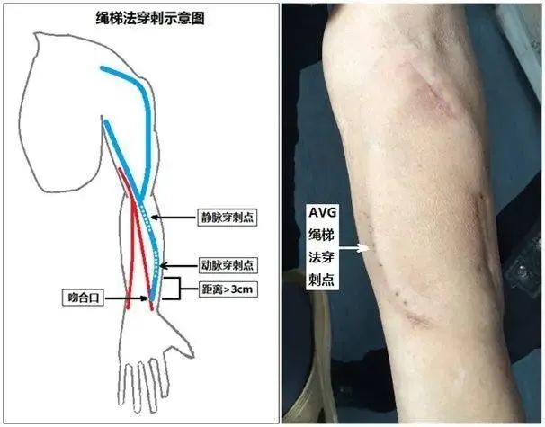 自体动静脉内瘘手术搭建尿毒症患者的生命线