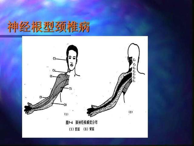 最常見的神經根型頸椎病居然有這麼多危害可能你已經得了