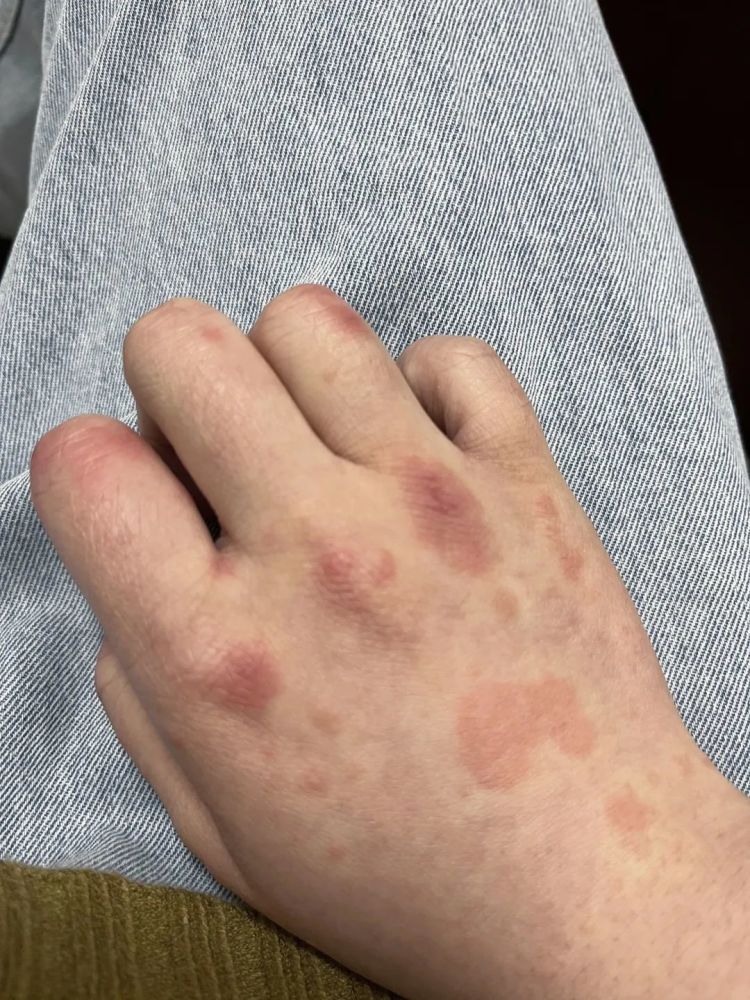 萧山一姑娘手上长了颗冻疮一周后事情变得有些严重了