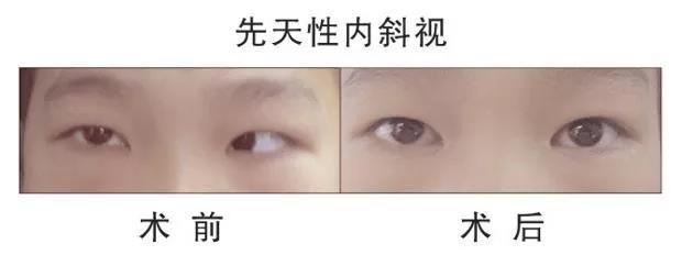 斜楞眼会随着年龄的增长恢复正常吗