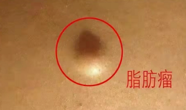 脾虚身上有脂肪瘤解读中成药香砂六君丸化痰健脾消瘤