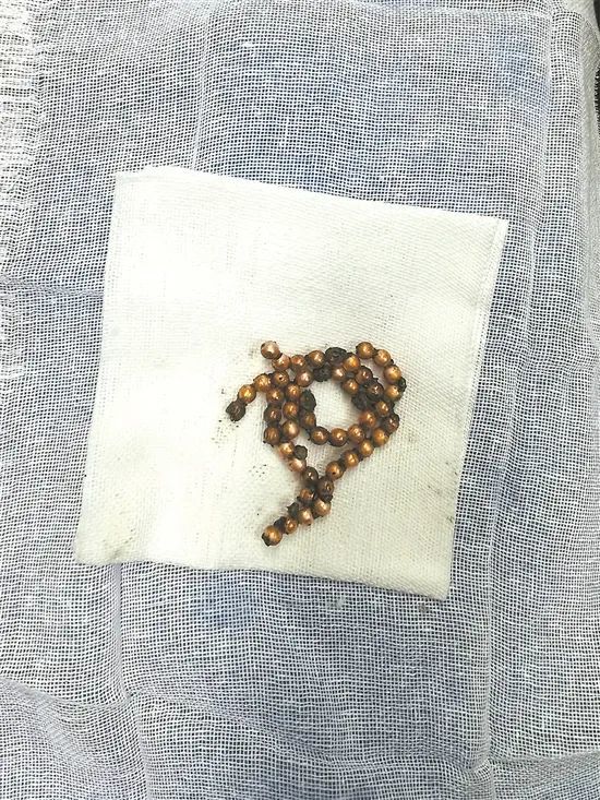 好疼晋江14岁男孩把40颗磁力珠塞进尿道