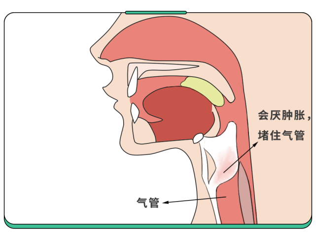 而会厌部位一旦被感染,就会发炎肿大,甚至肿大6-10倍,就像个肿胀的球