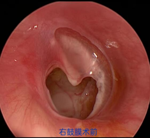 鼓膜穿孔检查图图片