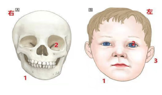 儿童康复别把歪脖当可爱警惕小儿斜颈