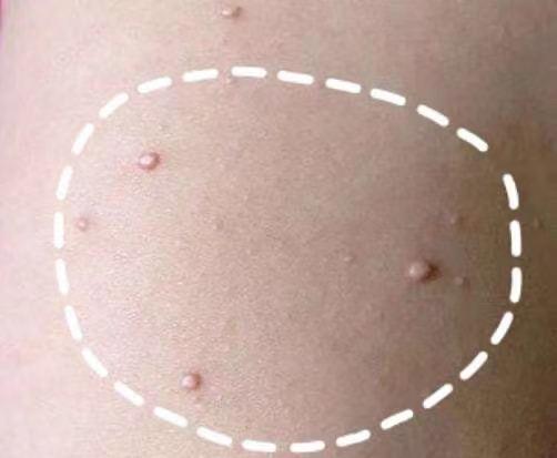 (图片来源于网络)一旦发现可能患上此种皮肤病,家长需要及早带孩子