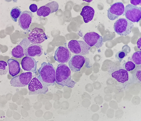 什么外周血成熟单核细胞显著增高竟然是急性白血病
