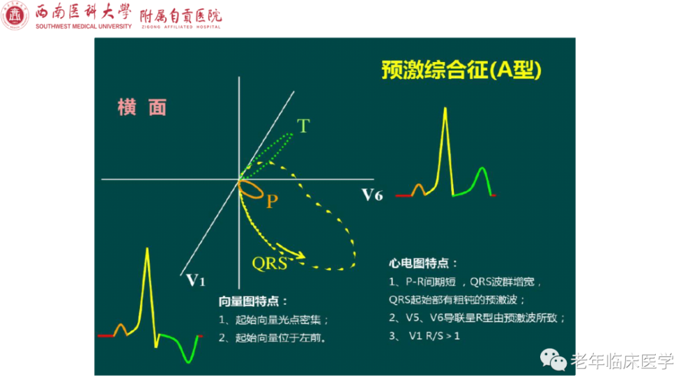 除上述心電圖特徵外,心電向量圖可作為診斷依據,其特徵是各個面上qrs