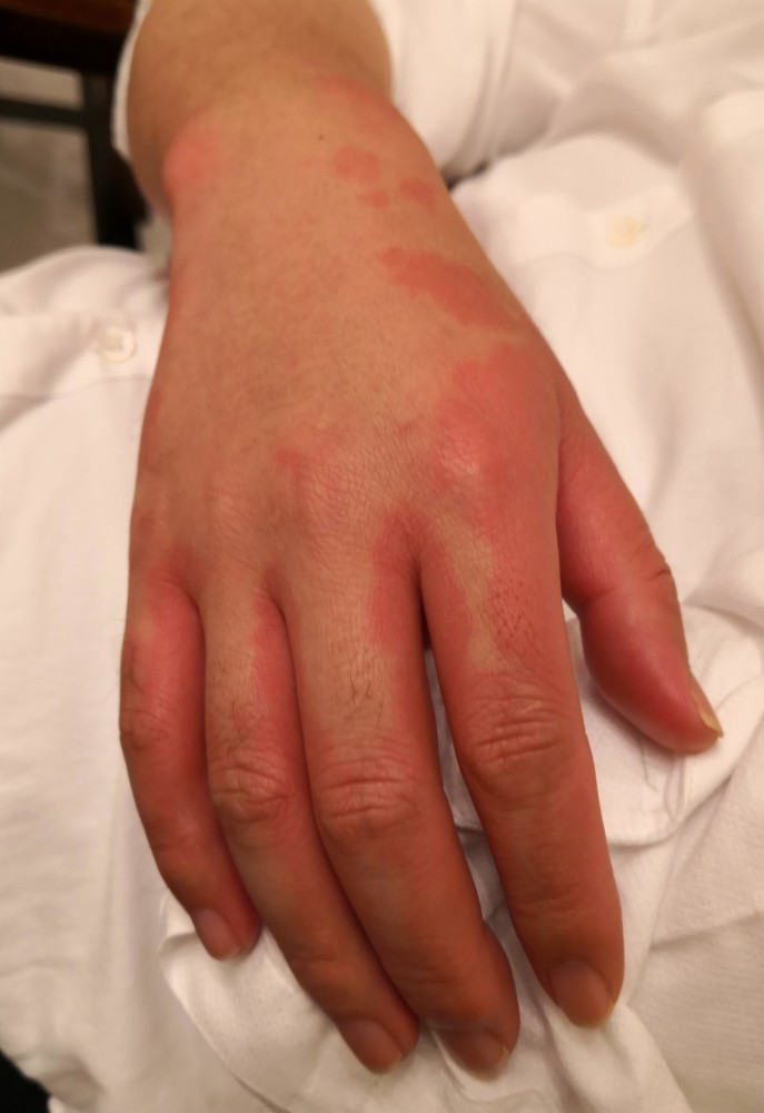 一些部位的皮肤一片一片地开始发红,说明这个人十有八九是酒精过敏的