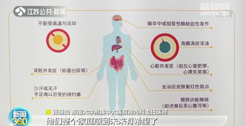 附属中大医院肾内科主任医师张晓良说:"我们中心诊断的法布雷病十几例