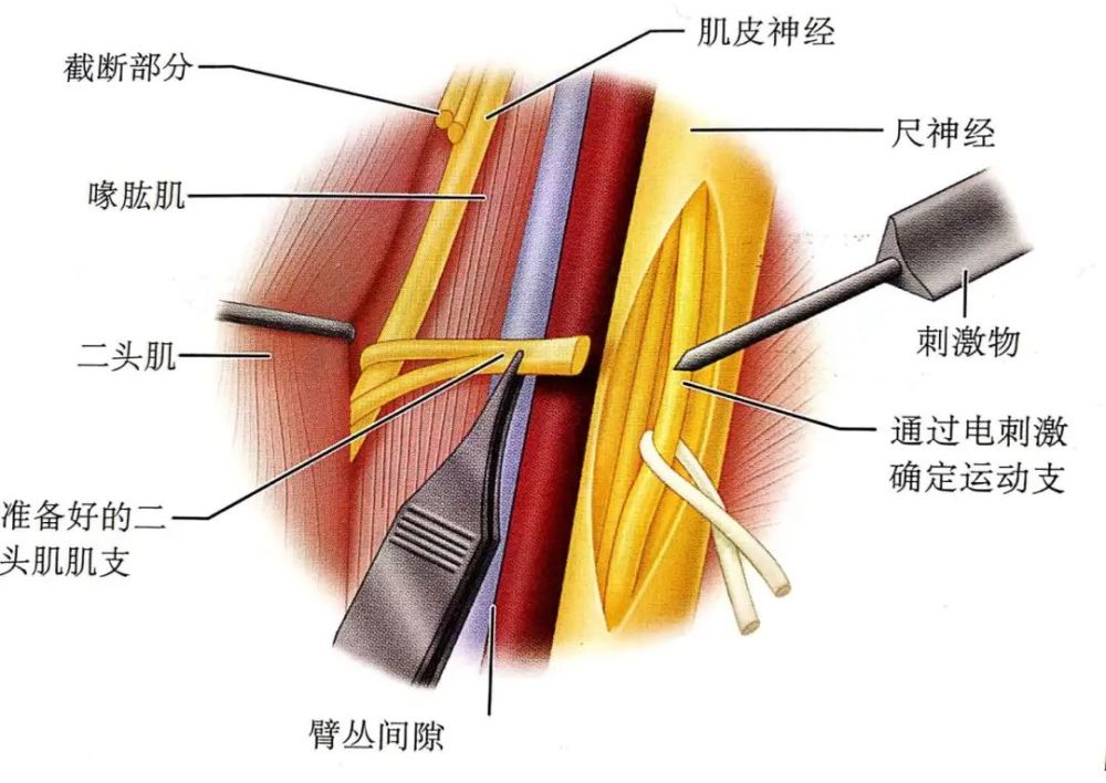 顯微解剖和神經束,神經內解剖並通過電刺激明確運動支將遠端由內側