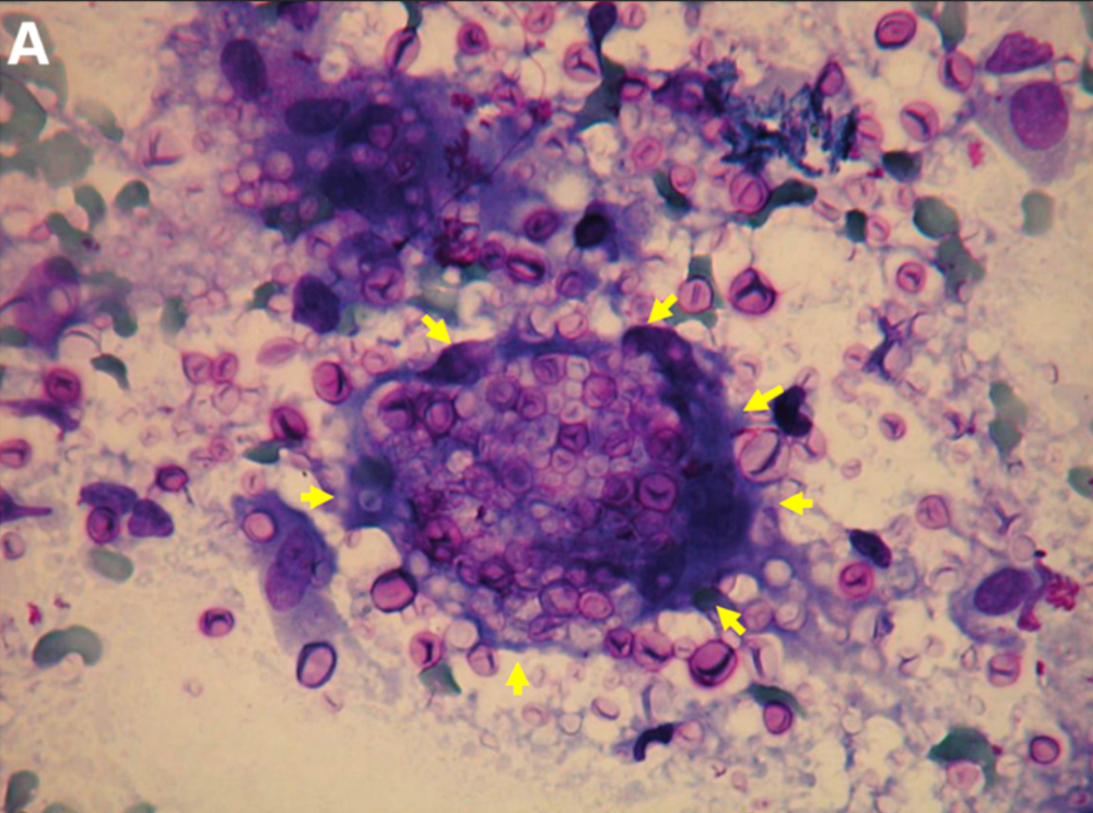 痰和肺穿刺塗片中的新型隱球菌