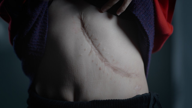 22岁独自去医院切下菜盆大的脾罕见病女孩拥有了超能力