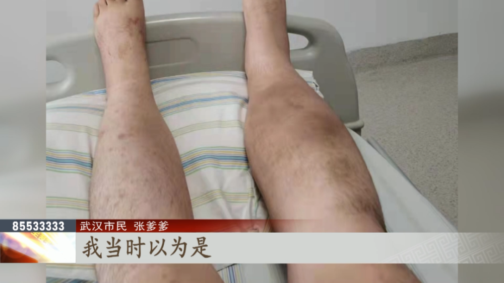 警惕双腿浮肿以为是没忌口糖尿病爹爹险些拖成肾衰竭