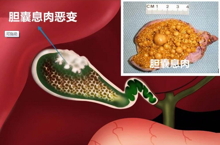 什么样的胆囊息肉需要切除看看最新版指南建议