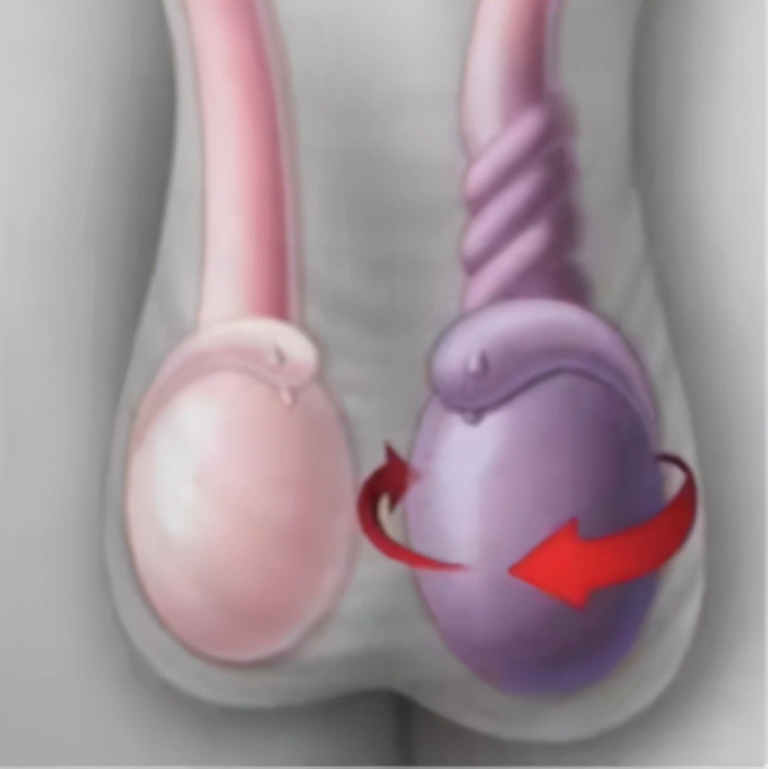 常见在睡觉,运动,外伤时刺激提睾肌,提睾肌收缩增强,导致提睾肌纤维