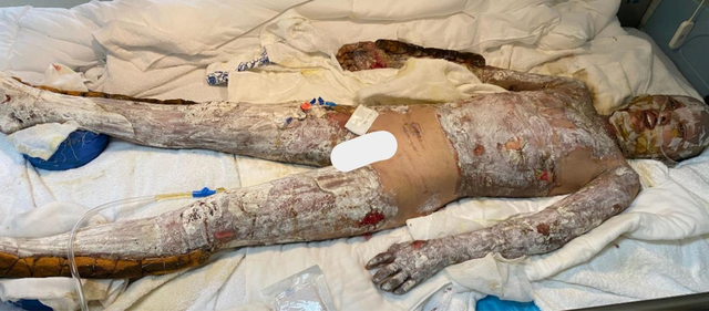 救助石泉烧伤女孩追踪爱心托起生命的希望烧伤女孩灵灵康复出院