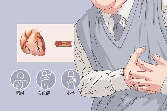 急性心梗堪比重大车祸如何远离