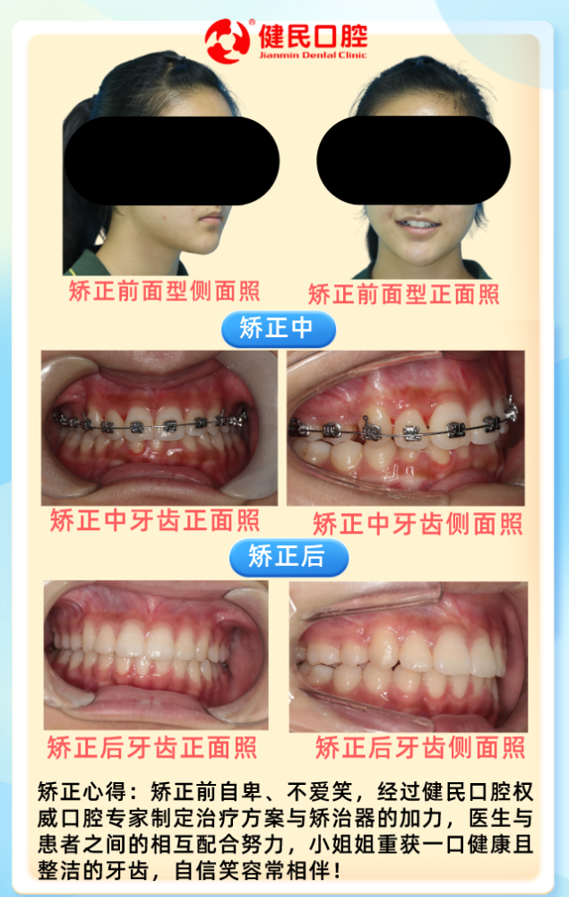 矫正案例17岁的小女孩牙齿前凸咬合不正金属矫正案例