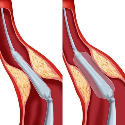 冠状动脉球囊扩张图片
