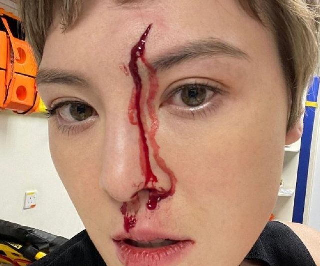 女星何慈茵高空拍戏受伤!