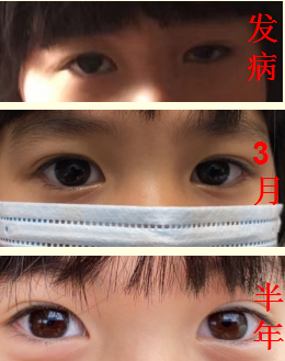 罕见病日中西医结合治重症肌无力疗效更佳副作用更少