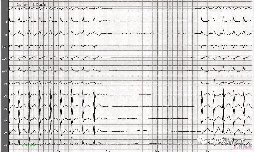 心电图图例分析68病窦综合征较久性全心停搏