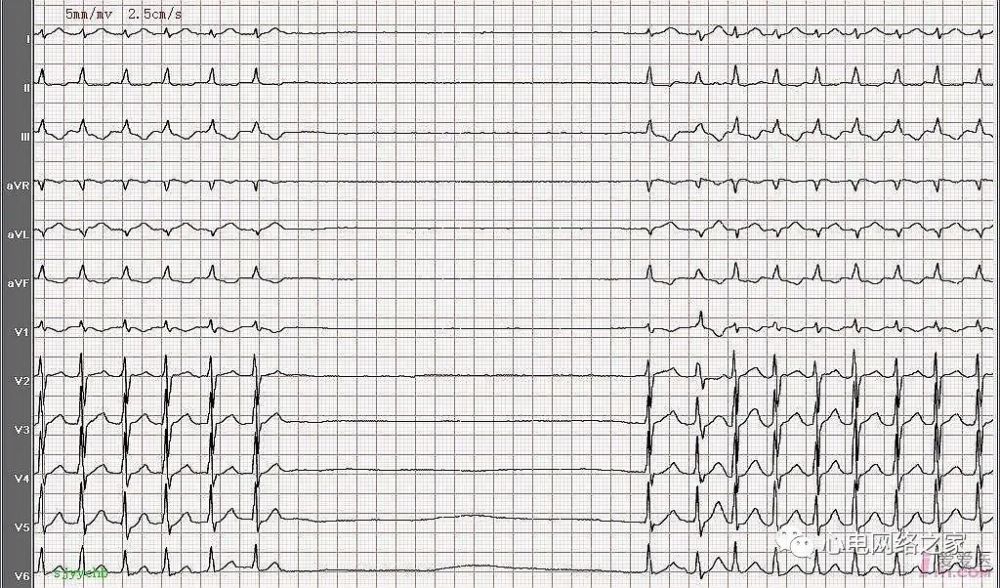 心电图图例分析68病窦综合征较久性全心停搏
