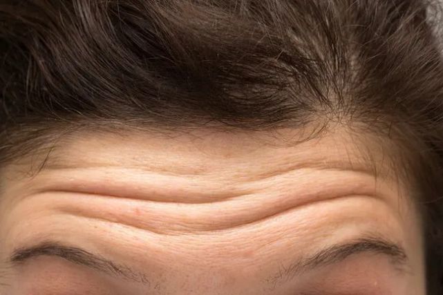 不敢相信才￥79不打针不开刀显老10岁额头纹抬头纹真的贴没了