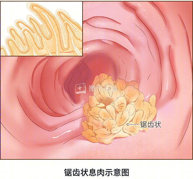 腫瘤性息肉包括腺瘤性息肉和鋸齒狀息肉[3].