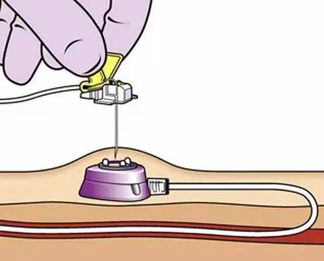 特色诊疗输液神器输液港一条看不见的生命线