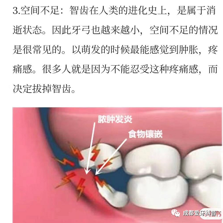 有一种痛叫着智齿发炎有一种侥幸叫我觉得不会发炎了不用拔智齿了
