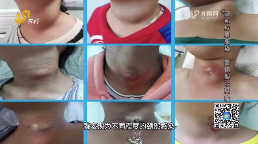 小儿耳鼻喉科主任田家军名医话健康栏目聊梨状窝瘘