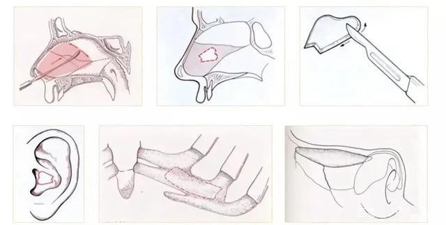 西安美萊耳軟骨隆鼻後耳朵會有疤痕嗎