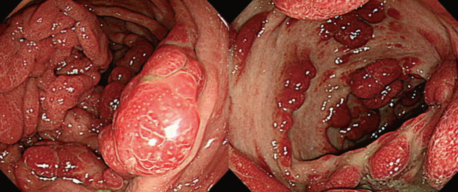 发现结肠息肉如何区分?这11张图你一定要掌握!