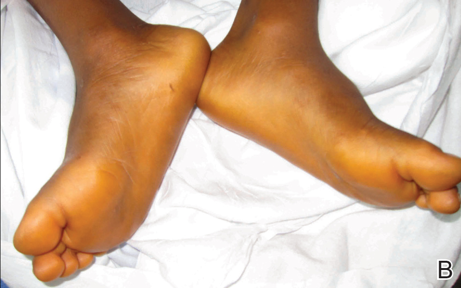 少数身体缺少消化分解胡萝卜素的特定酶的人群,才会得严重的橘黄症