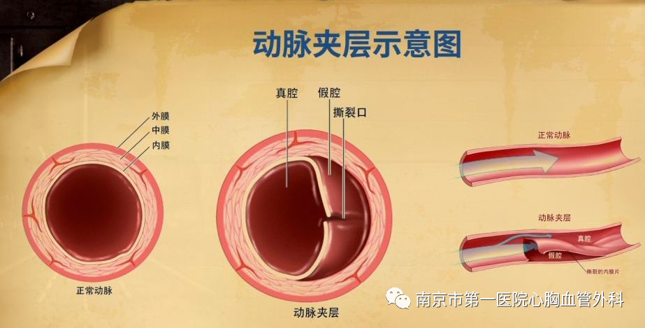 厚实的主动脉壁分为三层,内层,中层和外层,一些疾病会破坏基质层,使