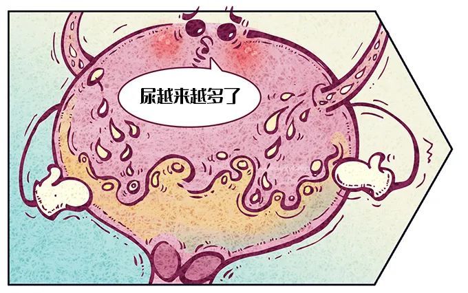 尿量不断增加,膀胱壁被撑得越来越薄,下方的"闸门"也岌岌可危.