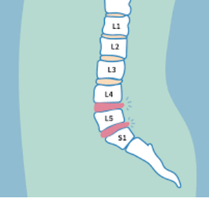 同时l4/5和l5/s1承担了人体约60%的身体重量,再加上日常生活中对腰椎